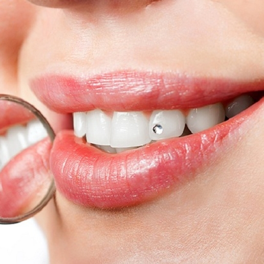Mặt dán sứ venner kim cương