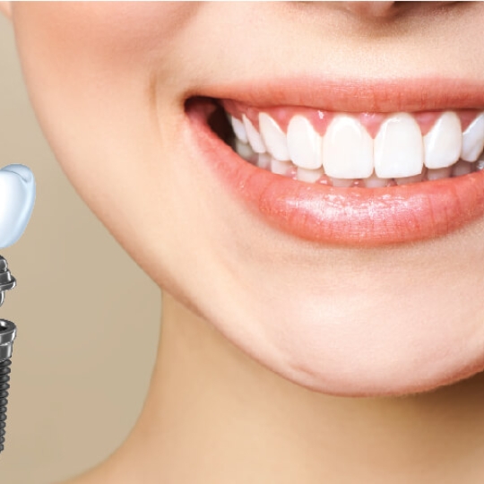 Trồng implatn chất lượng cao  giá ưu đãi 