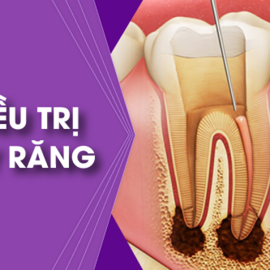 Điều Trị, Chữa Tủy Răng