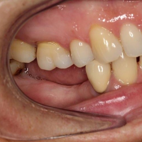 Trồng implatn chất lượng cao  giá ưu đãi 