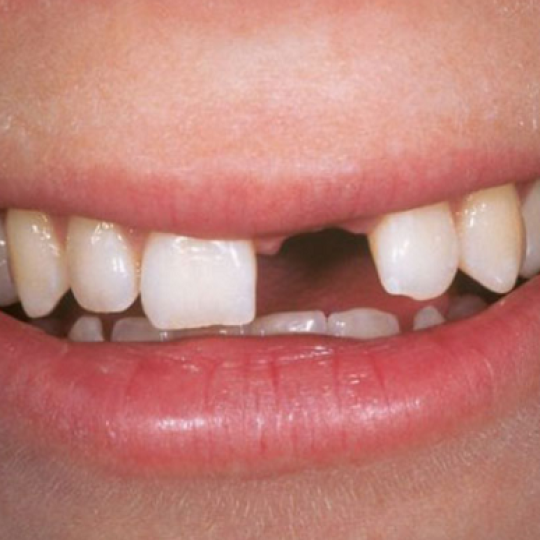 Trồng implatn chất lượng cao  giá ưu đãi 