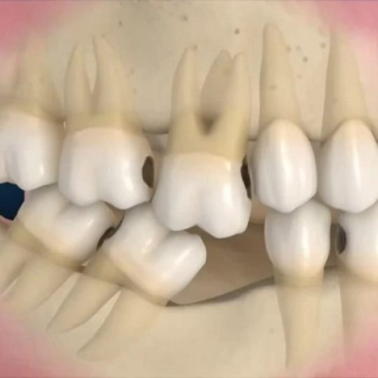 Trồng implatn chất lượng cao  giá ưu đãi 