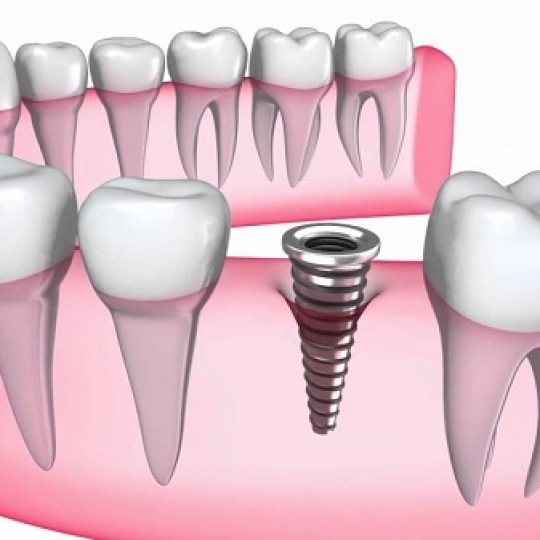 Trồng implatn chất lượng cao  giá ưu đãi 