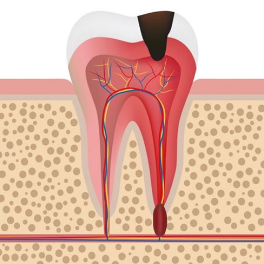 Điều Trị, Chữa Tủy Răng