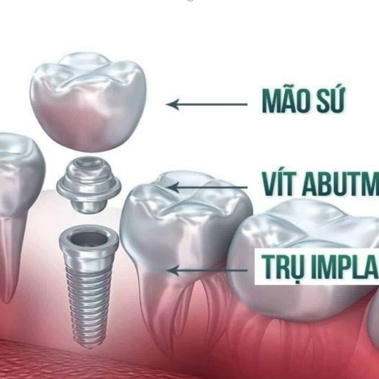 Trồng implatn chất lượng cao  giá ưu đãi 